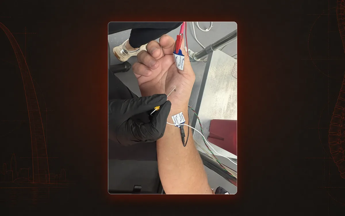 Nerve conduction testing with stimulation of the median nerve at the wrist.